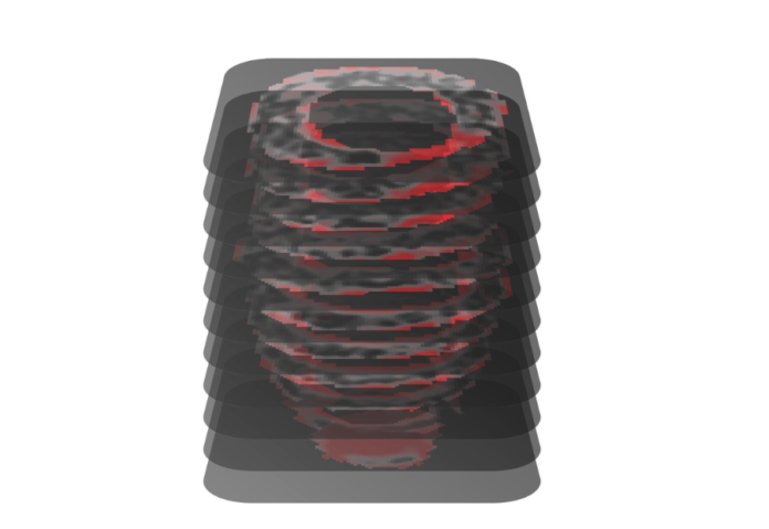 New AI Tool MAARS Accurately Predicts Sudden Cardiac Death Risk in HCM Patients