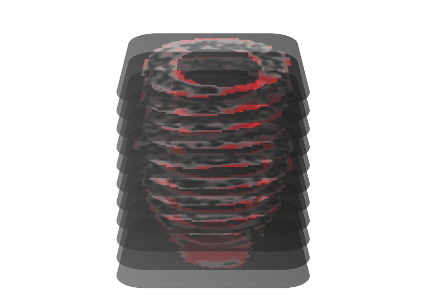 New AI Tool MAARS Accurately Predicts Sudden Cardiac Death Risk in HCM Patients